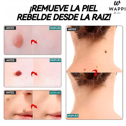 Removedor de Verrugas Wart Remover Spray (30 ml) – Elimina Verrugas en Casa, Sin Dolor y con Precisión