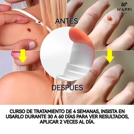 Removedor de Verrugas Wart Remover Spray (30 ml) – Elimina Verrugas en Casa, Sin Dolor y con Precisión
