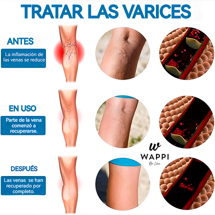 🦵💜Kit Antivarices Spray + 12 Parches regalo | Tratamiento No Invasivo, un Alivio para tus varices