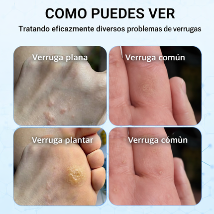 WART REMOVER – Crema Herbal para Reducir y Eliminar Verrugas