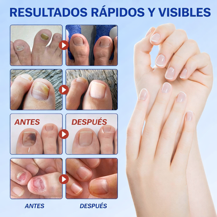 Parches Anti Hongos para Uñas – 21 Pcs, Resultados Reales