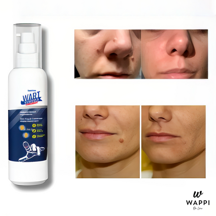 Removedor de Verrugas Wart Remover Spray (30 ml) – Elimina Verrugas en Casa, Sin Dolor y con Precisión