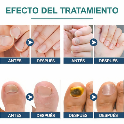 Parche para Hongos en las Uñas – Pack 3