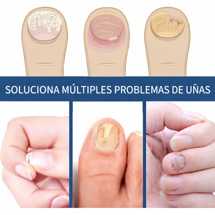 Parche para Hongos en las Uñas – Pack 3